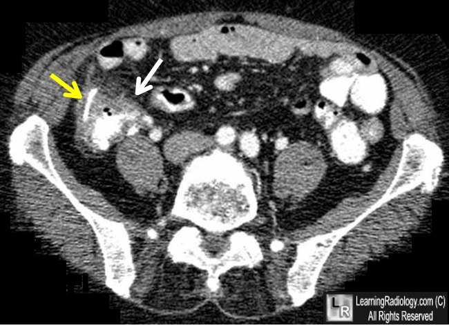 perforation bowel from chicken bone
